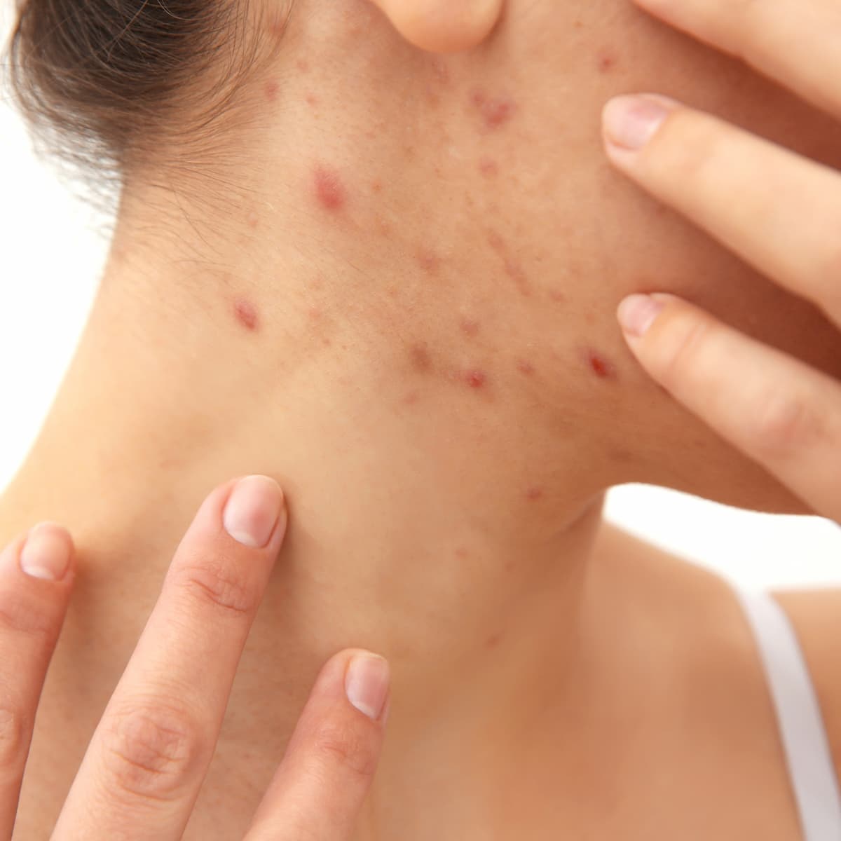 Explore the link between whey protein intake and skin health. Understand how whey may contribute to acne and discover skin-friendly alternatives like Roam Protein for a clearer complexion.
