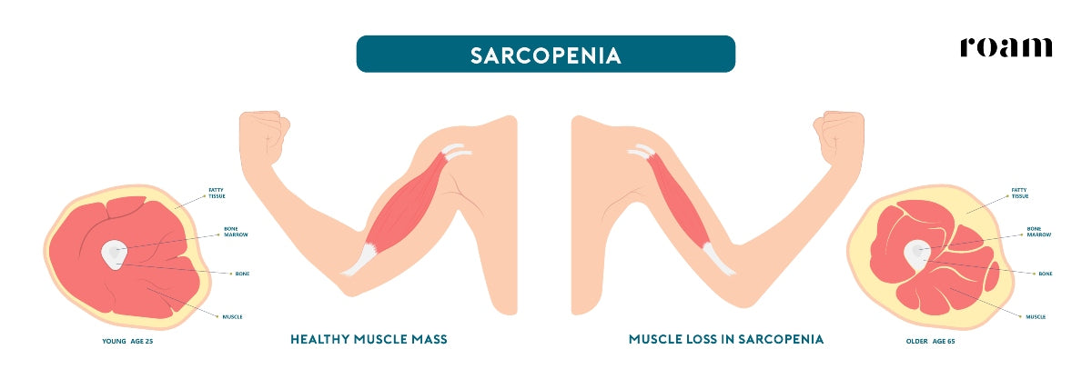 Healthy Muscle Vs Muscle Loss in Sarcopenia