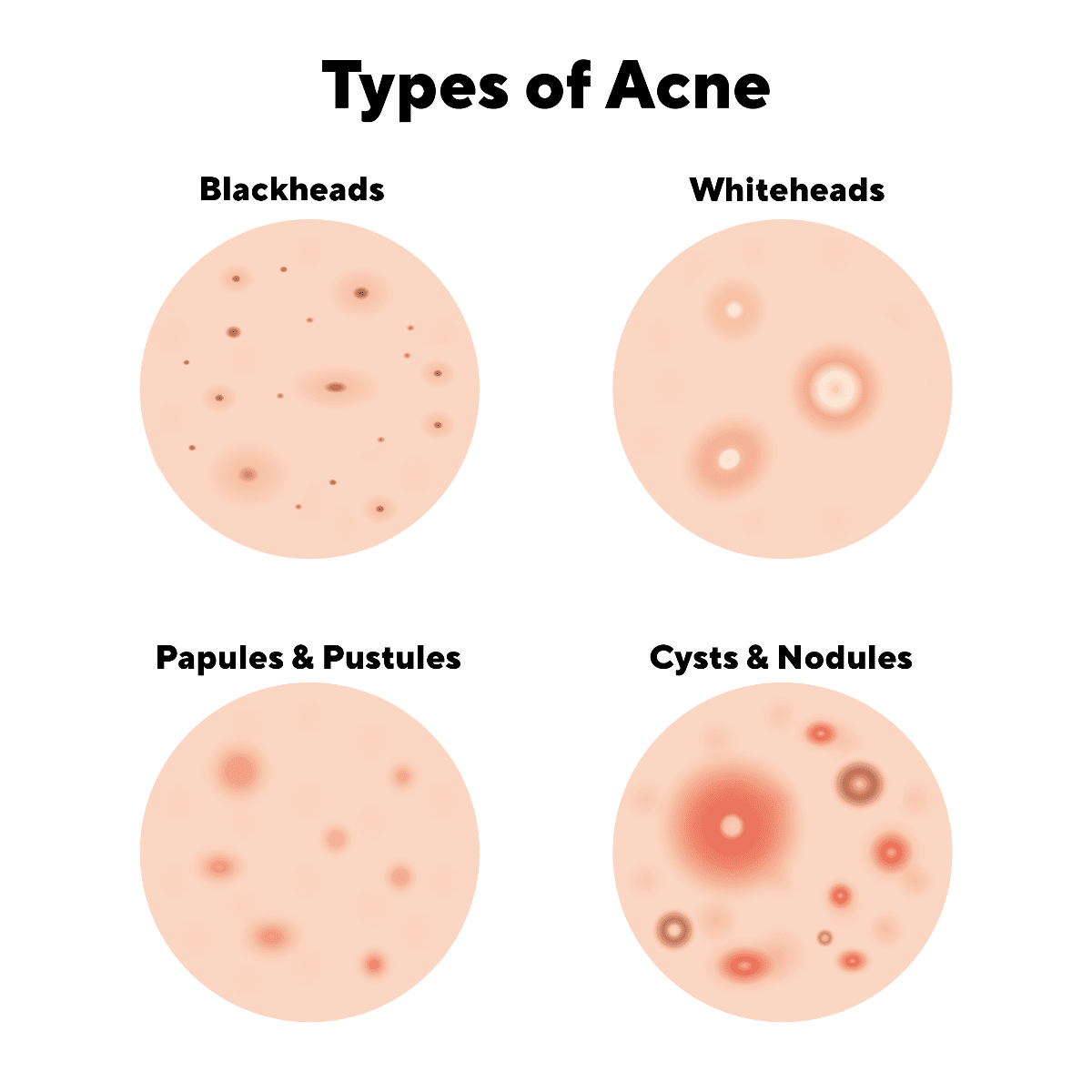 Understand types of acne, from comedones to cysts, potentially triggered by whey protein.